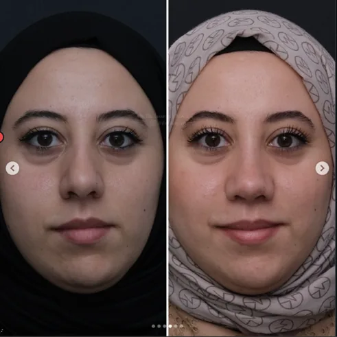 Rhinoplasty