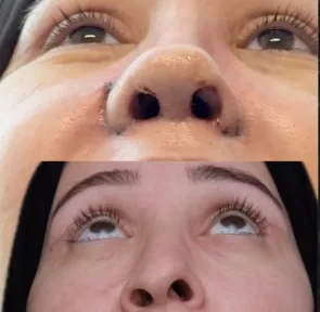 Rhinoplasty