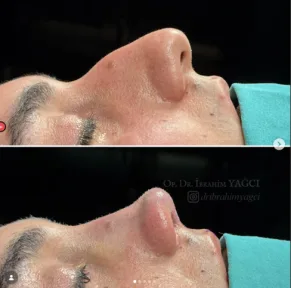Rhinoplasty
