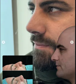 Rhinoplasty