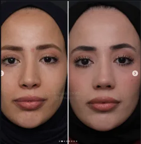 Rhinoplasty