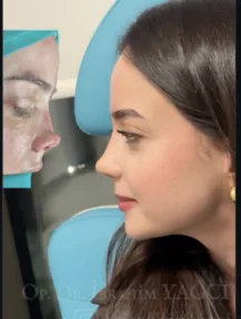 Rhinoplasty
