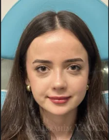 Rhinoplasty