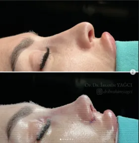 Rhinoplasty
