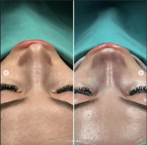 Rhinoplasty