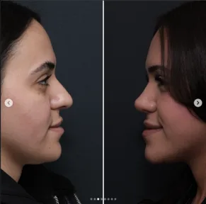Rhinoplasty