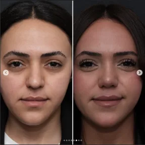 Rhinoplasty