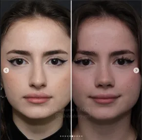 Rhinoplasty