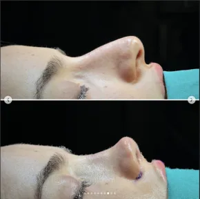 Rhinoplasty