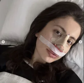 Rhinoplasty
