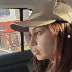 Rhinoplasty