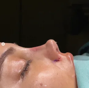 Rhinoplasty