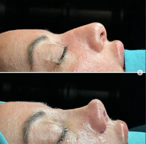 Rhinoplasty