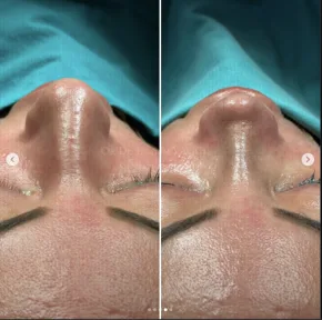 Rhinoplasty