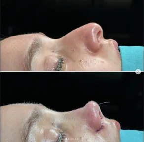Rhinoplasty