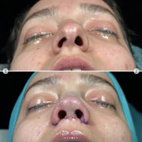 Rhinoplasty
