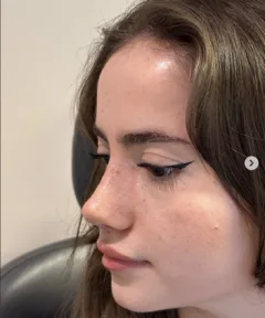Rhinoplasty