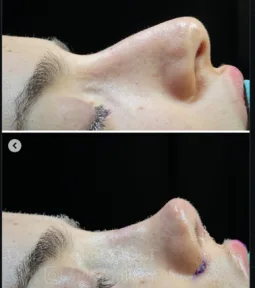 Rhinoplasty