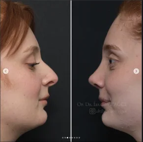 Rhinoplasty