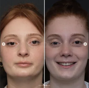 Rhinoplasty