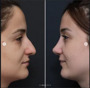 Rhinoplasty