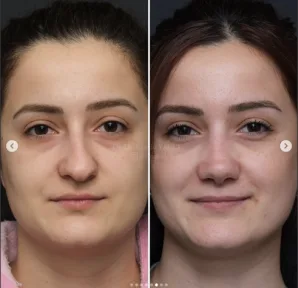 Rhinoplasty