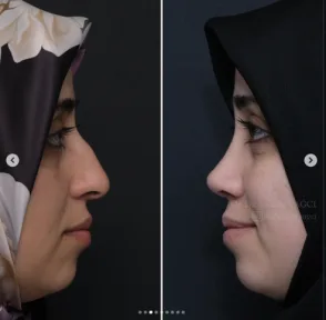 Rhinoplasty
