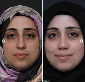 Rhinoplasty
