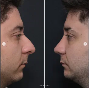 Rhinoplasty