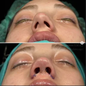 Rhinoplasty