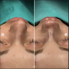 Rhinoplasty