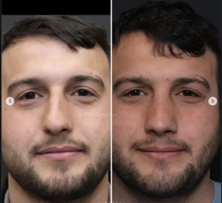 Rhinoplasty