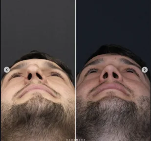 Rhinoplasty