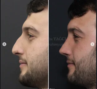 Rhinoplasty