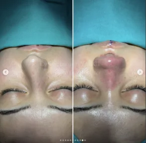 Rhinoplasty