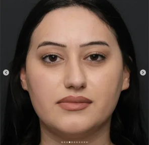 Rhinoplasty