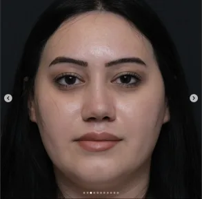 Rhinoplasty