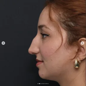 Rhinoplasty