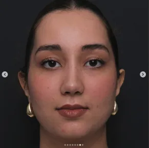 Rhinoplasty
