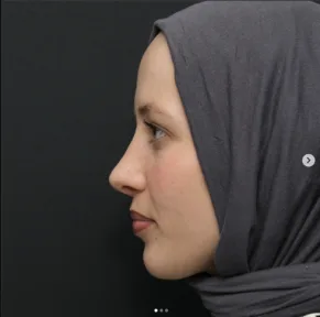 Rhinoplasty