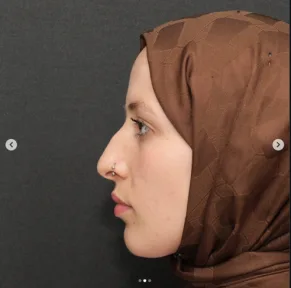 Rhinoplasty