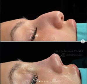 Rhinoplasty