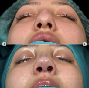 Rhinoplasty