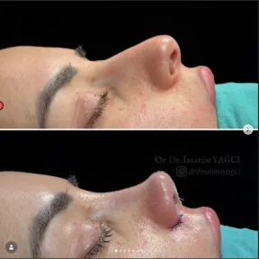 Rhinoplasty