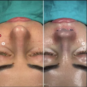 Rhinoplasty