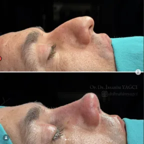 Rhinoplasty