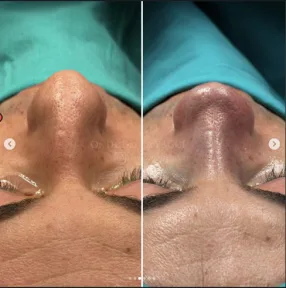 Rhinoplasty