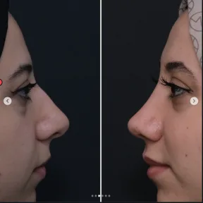 Rhinoplasty