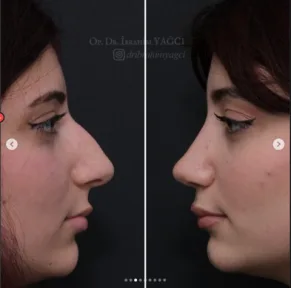 Rhinoplasty