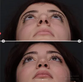 Rhinoplasty